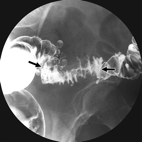 Diverticulitis X Ray