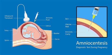 What is Amniocentesis?