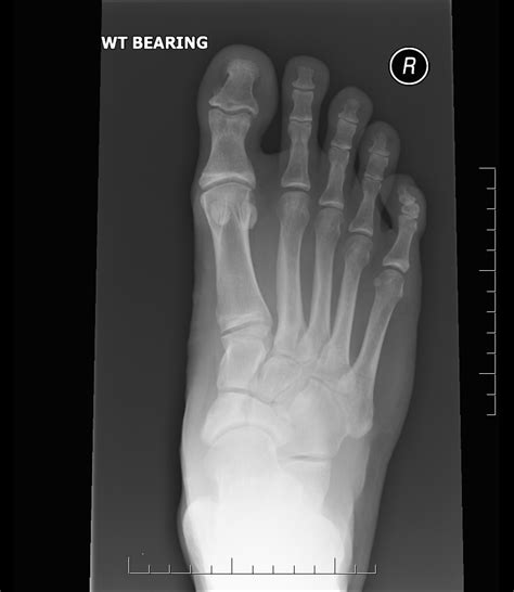 Navicular fractures | The Bone School