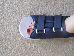 Broken Toe | Surgical Shoe | Houston Podiatrist | Tanglewood Foot Specialists