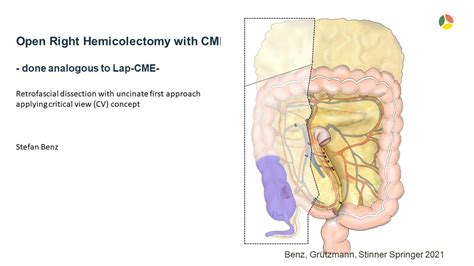 Open right hemicolectomy with complete mesocolic excision (CME) and ...