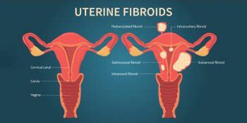 Enlarged Uterus Complications - Causes, and Treatments - Pristyn Care