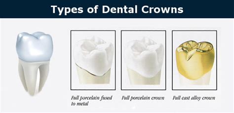 Dental Crowns Burbank | My Dentist Burbank