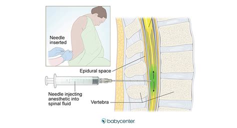 Spinal block for labor pain: pros and cons | BabyCenter