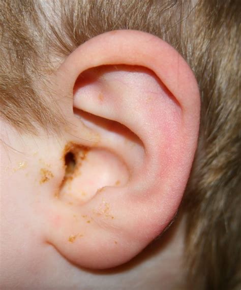 Ear Infection (Middle Ear) Causes, Symptoms, Diagnosis and Treatment ...