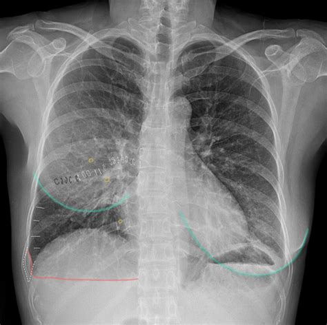 Pleural Effusion X Ray Lateral