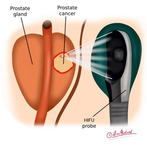 HIFU for Prostate Cancer