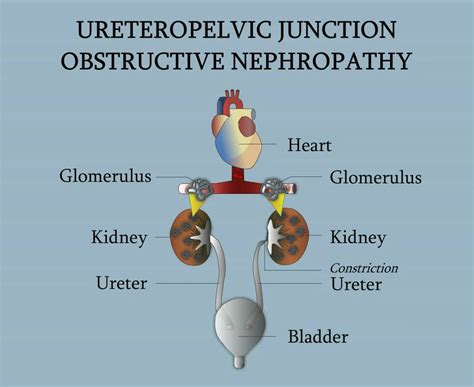 Ureteropelvic Junction - Obstructive Nephropathy - YouTube