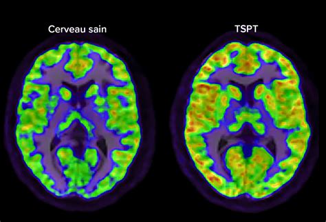 En images : ces pathologies ou activités qui modifient le cerveau