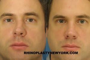 Broken Nose Surgery Procedures New York City, NY | Dr. Philip Miller