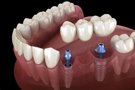 Dental Bridge vs Implant - Pros and Cons and How To Choose | Somerset ...