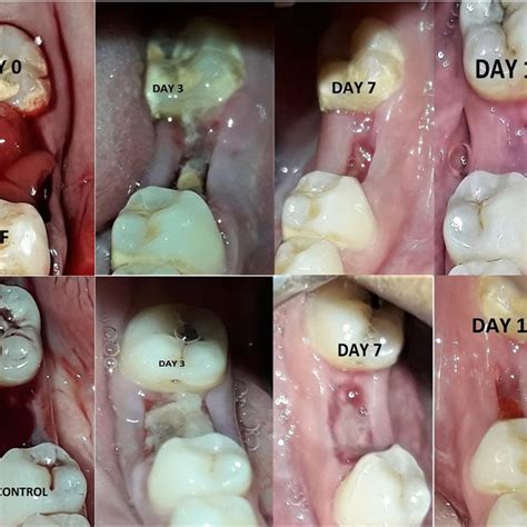 (A) Soft tissue healing at extraction socket with the platelet-rich ...