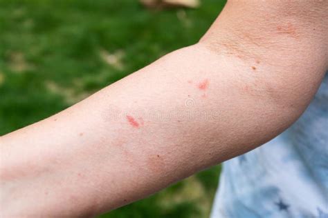 Poison Ivy Spots and Blisters on Woman`s Arm Stock Image - Image of ...