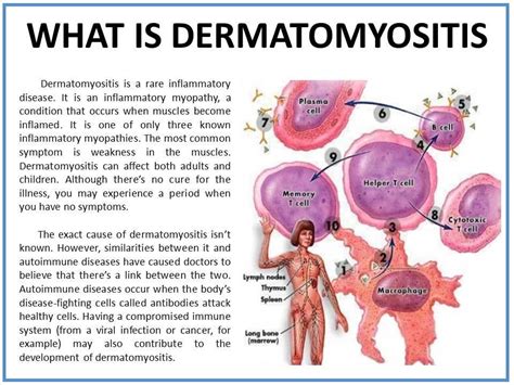 Dermatomyositis https://www.facebook.com/CassandrasJourneywithJDM?ref=stream | Dermatomyositis ...