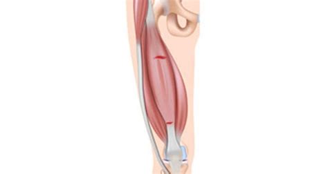 Upper thigh pain Archives - Sportsinjuryclinic.net