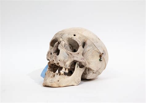 Trepanned Medical Skull (0228) | JonsBones: Responsibly Sourced Human ...