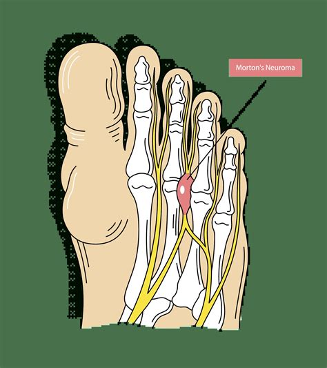 Morton's Neuroma: Treatment, Symptoms & Causes - The Foot Hub