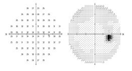 Plaquenil & Ethambutol Eye Tests Sydney & Parramatta - Westmead Eyes Optometrists