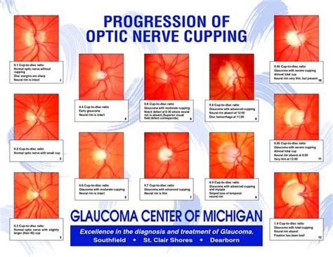 Photos Of Glaucoma Optic Nerve Cupping