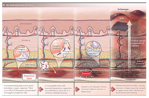 Necrotizing Fasciitis Pathophysiology