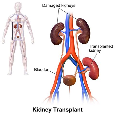 Transplant Surgery - Kidney Transplant