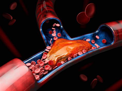 Thrombose veineuse cérébrale: Causes, Symptômes et Traitement