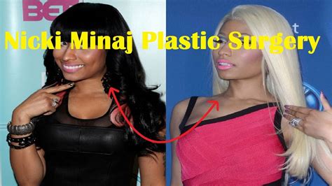 NICKI MINAJ BEFORE AND AFTER SURGERY