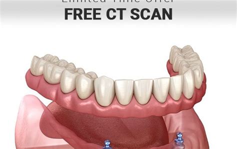 The Importance of 3D CT-Scan for Dental Implant Surgery.