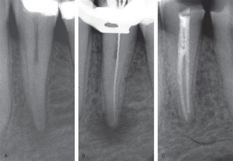 Apical Periodontitis Radiograph