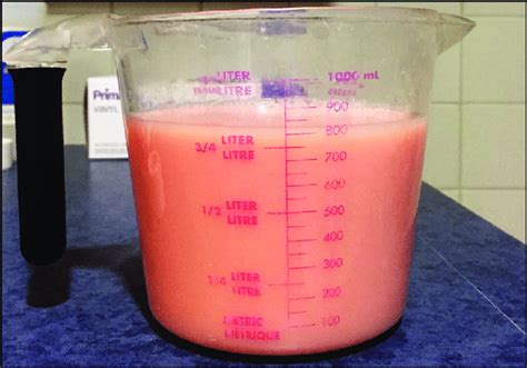 Chyle drained from the thorax through thoracocentesis during patient... | Download Scientific ...