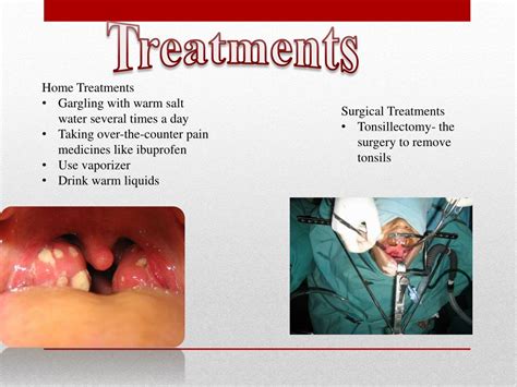 Tonsillitis Pathophysiology