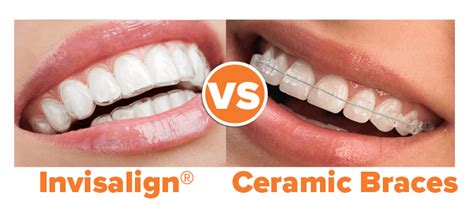 How Much Do Clear Braces Cost vs. Invisalign? - NCOSO