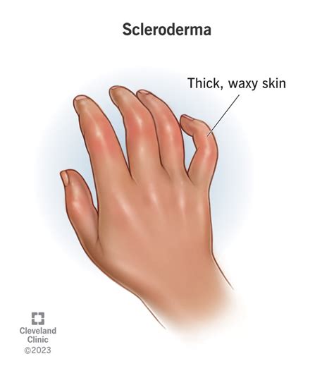 Scleroderma: Symptoms, Causes & Treatment Options