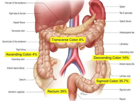 Carcinoma Colon And Management | Sigmoid colon, Colon, Chronic migraines