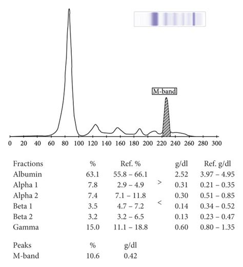 Serum protein electrophoresis showing an M protein of 4.2 g/l. | Download Scientific Diagram