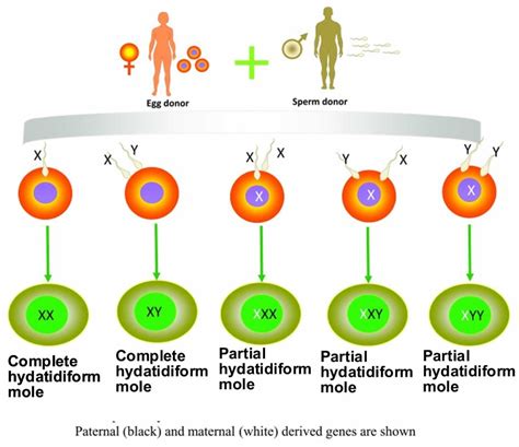 Hydatidiform mole meaning, causes, signs, symptoms, diagnosis & treatment