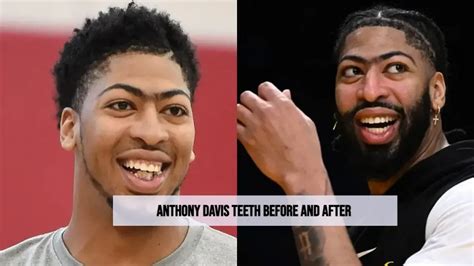 Anthony Davis' Astonishing Teeth Transformation: Before And After ...