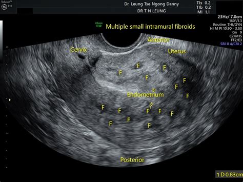 Uterine fibroid (leiomyoma) - HKOG-INFO