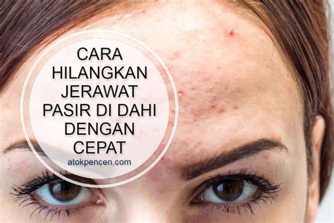 Cara Hilangkan Jerawat Pasir Di Dahi Dengan Cepat!