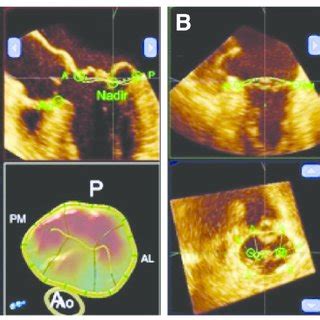 Dynamic model of the mitral valve in Barlow disease (a) and FED (b ...