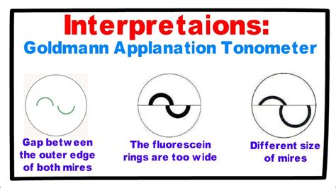 Interpretations- Goldmann Applanation Tonometer. - YouTube