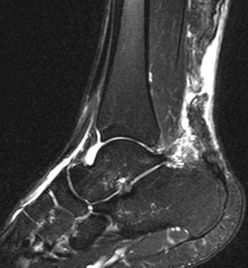 Achilles Tendinosis & Achilles Tendon Rupture | Radsource