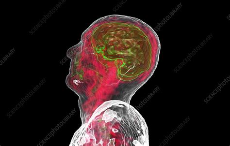 Human brain, PET-CT scan - Stock Image - C047/6368 - Science Photo Library