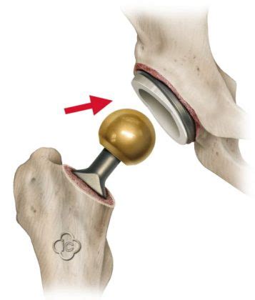 Advantages and Disadvantages of a Ceramic Hip-Replacement - Mencoret | Breaking the Internet