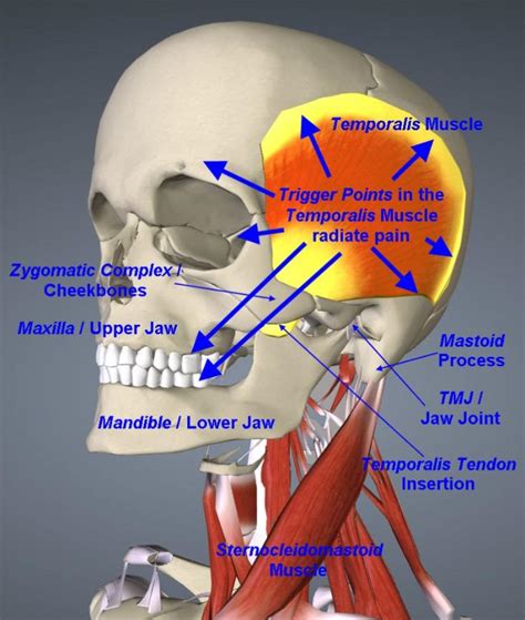 Temporalis Tendonitis – Exodontia