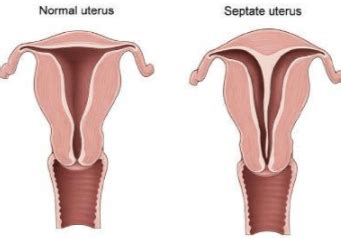 Uterine Septum | Dr Tamara Hunter | Specialist Gynaecologist | Perth