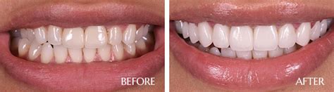 Cosmetic Dentistry Scottsdale, AZ - Implant Dentist - Smile Makeover