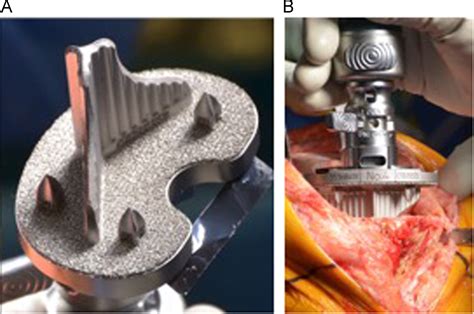 Cementless total knee arthroplasty: Patient selection and surgical techniques to optimize ...