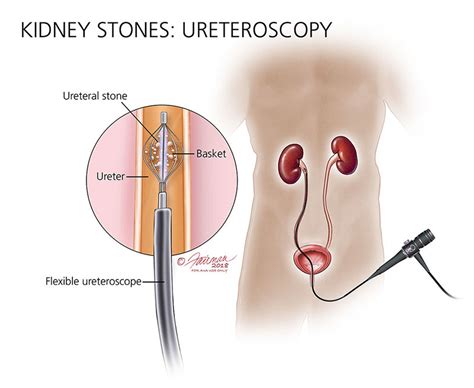 Kidney Stones: Symptoms, Diagnosis & Treatment - Urology Care Foundation