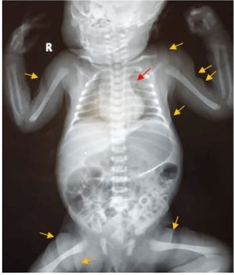 Cureus | Arterial Tortuosity Syndrome in a Newborn: A Case Report With Literature Review